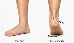 ओवरप्रोनेशन (Overpronation) वाले पैरों की पहचान और उनके लिए ऑर्थोपेडिक जूते