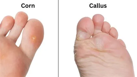 कॉर्न्स और कॉलस (Corns and Calluses - गोखरू)