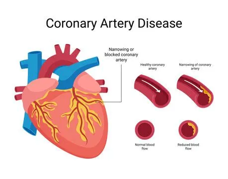 कोरोनरी आर्टरी डिजीज (Coronary Artery Disease)