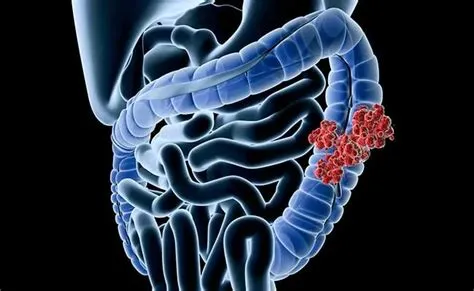 कोलोरेक्टल कैंसर (Colorectal Cancer / आंत का कैंसर)