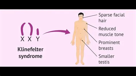 क्लाइनफेल्टर सिंड्रोम (Klinefelter Syndrome)