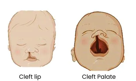 क्लैफ्ट लिप और तालु (Cleft Lip and Palate - कटा हुआ होंठ)