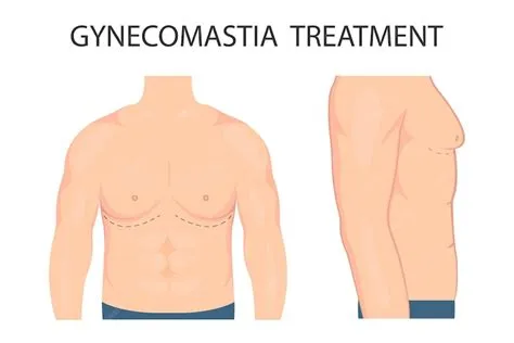 गाइनेकोमेस्टिया (Gynecomastia)
