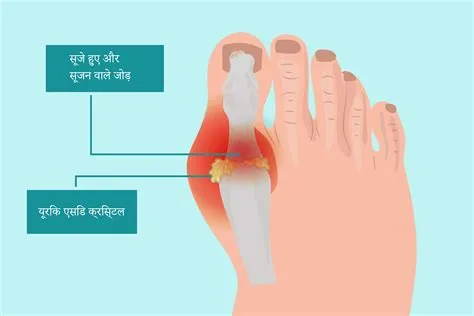 गाउट (Gout / यूरिक एसिड का बढ़ना)
