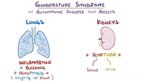 गुडपाश्चर सिंड्रोम (Goodpasture Syndrome)
