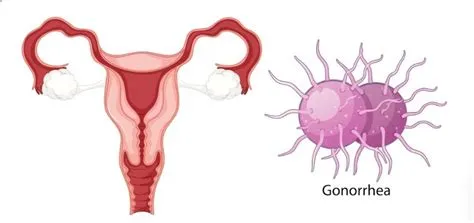 गोनोरिया (Gonorrhea)