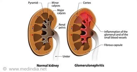 ग्लोमेरुलोनेफ्राइटिस (Glomerulonephritis)