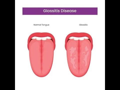 ग्लोसाइटिस (Glossitis - जीभ की सूजन)