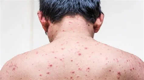 चिकनपॉक्स (Chickenpox / छोटी माता)