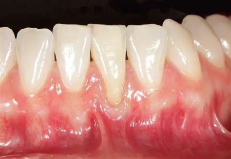 जिंजिवल रिसेशन (Gingival Recession - मसूड़ों का खिसकना)
