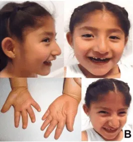 टर्नर सिंड्रोम (Turner Syndrome)