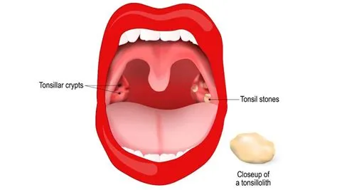टॉन्सिलिटिस (Tonsillitis - टॉन्सिल्स का संक्रमण)