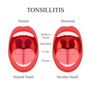 टॉन्सिलिटिस (Tonsillitis / टॉन्सिल्स की सूजन)