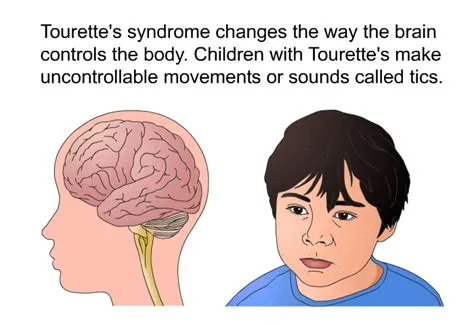टौरेटे सिंड्रोम (Tourette Syndrome)
