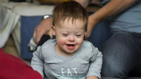 डाउन सिंड्रोम (Down Syndrome)