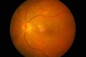 डायबिटिक मैकुलर एडिमा (Diabetic Macular Edema)