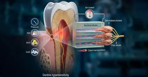 डेंटीन हाइपरसेंसिटिविटी (Dentin Hypersensitivity - दांतों में झनझनाहट)