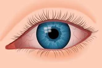 ड्राई आई सिंड्रोम (Dry Eye Syndrome)