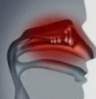 नासल पॉलीप्स (Nasal Polyps - नाक में मांस बढ़ना)