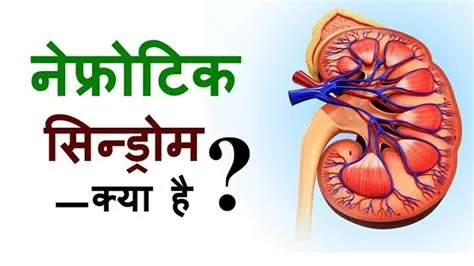 नेफ्रोटिक सिंड्रोम (Nephrotic Syndrome)