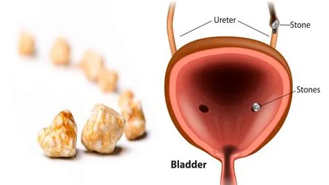 न्यूरोजेनिक ब्लैडर (Neurogenic Bladder - नसों की कमजोरी से पेशाब न रोक पाना)