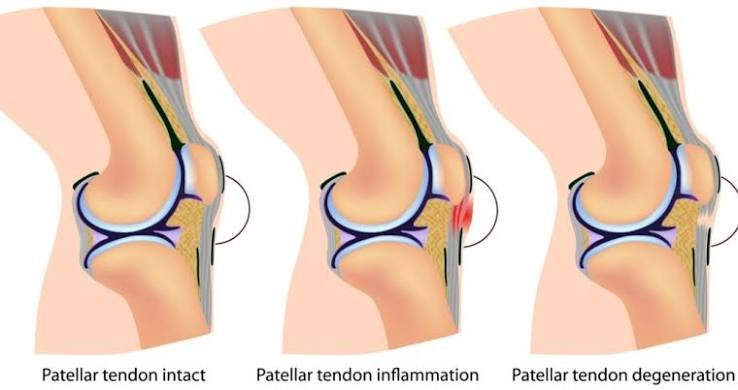 पटेला टेंडिनाइटिस (Jumper’s Knee): घुटने के आगे के हिस्से में दर्द का इलाज