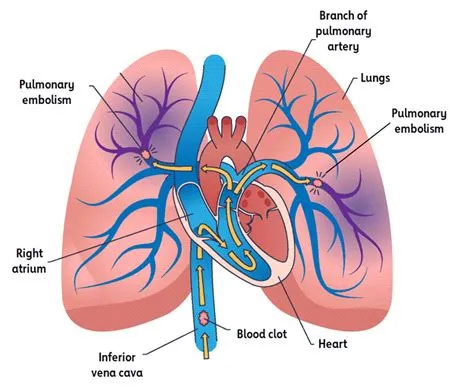 पल्मोनरी एम्बोलिज्म (Pulmonary Embolism)