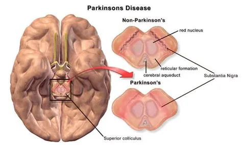 पार्किंसंस रोग (Parkinson's Disease)