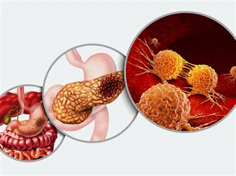 पैन्क्रियाटाइटिस (Pancreatitis / अग्नाशय की सूजन)