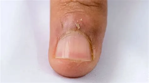पैरोनीशिया (Paronychia - नाखूनों के आसपास सूजन)