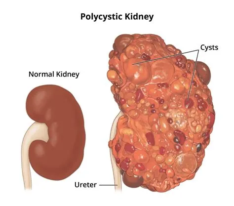 पॉलीसिस्टिक किडनी डिजीज (PKD)