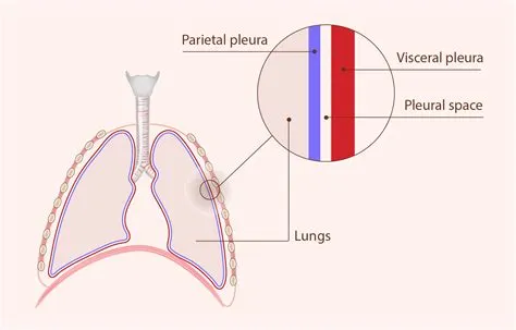 प्लूरिसी (Pleurisy / फेफड़ों की झिल्ली में सूजन)