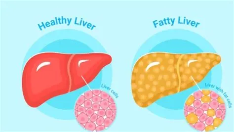 फैटी लिवर - नॉन-अल्कोहलिक (NAFLD)