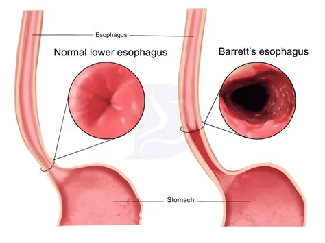 बैरेट एसोफेगस (Barrett's Esophagus)