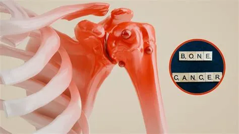 बोन कैंसर (Bone Cancer / हड्डियों का कैंसर)