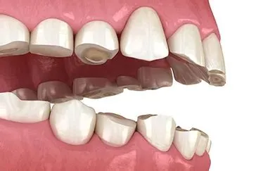 ब्रुक्सिज्म (Bruxism - नींद में दांत पीसना)