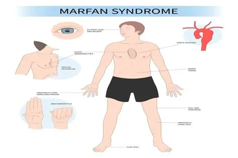 मारफन सिंड्रोम (Marfan Syndrome)