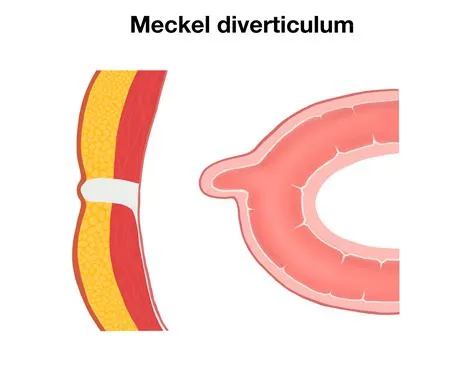 मेकेल डायवर्टीकुलम (Meckel's Diverticulum)