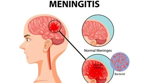 मेनिन्जाइटिस (Meningitis / दिमागी बुखार)