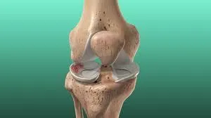 मेनिस्कस (घुटने की गद्दी) की सर्जरी के बाद पैर पर वजन डालने (Weight Bearing) के नियम