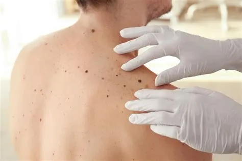 मेलेनोमा (Melanoma / स्किन कैंसर)