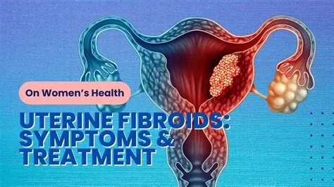 यूटेराइन फाइब्रॉएड (Uterine Fibroids / बच्चेदानी में गांठ)