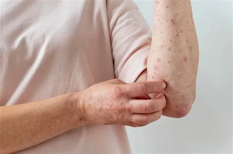 रूबेला (Rubella)