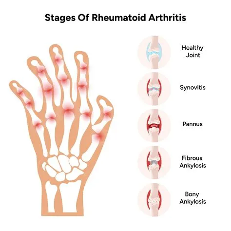 रूमेटाइड अर्थराइटिस (Rheumatoid Arthritis / गठिया बाय)