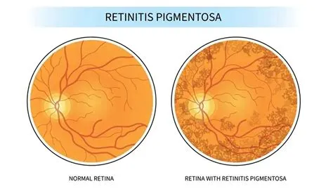 रेटिनाइटिस पिगमेंटोसा (Retinitis Pigmentosa)