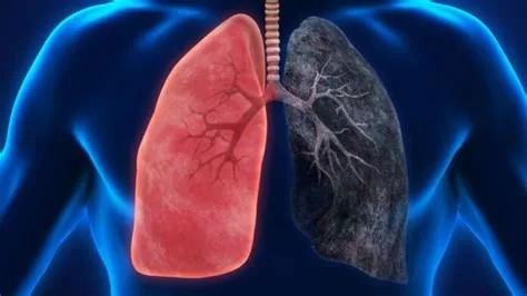 लंग कैंसर (Lung Cancer / फेफड़ों का कैंसर)