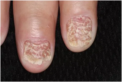 लिचेन प्लानस (Lichen Planus)