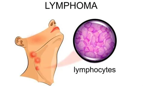 लिम्फोमा (Lymphoma)
