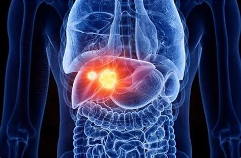 लिवर कैंसर (Liver Cancer)