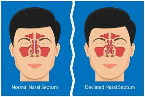 विचलित नाक का सेप्टम (Deviated Nasal Septum - DNS)